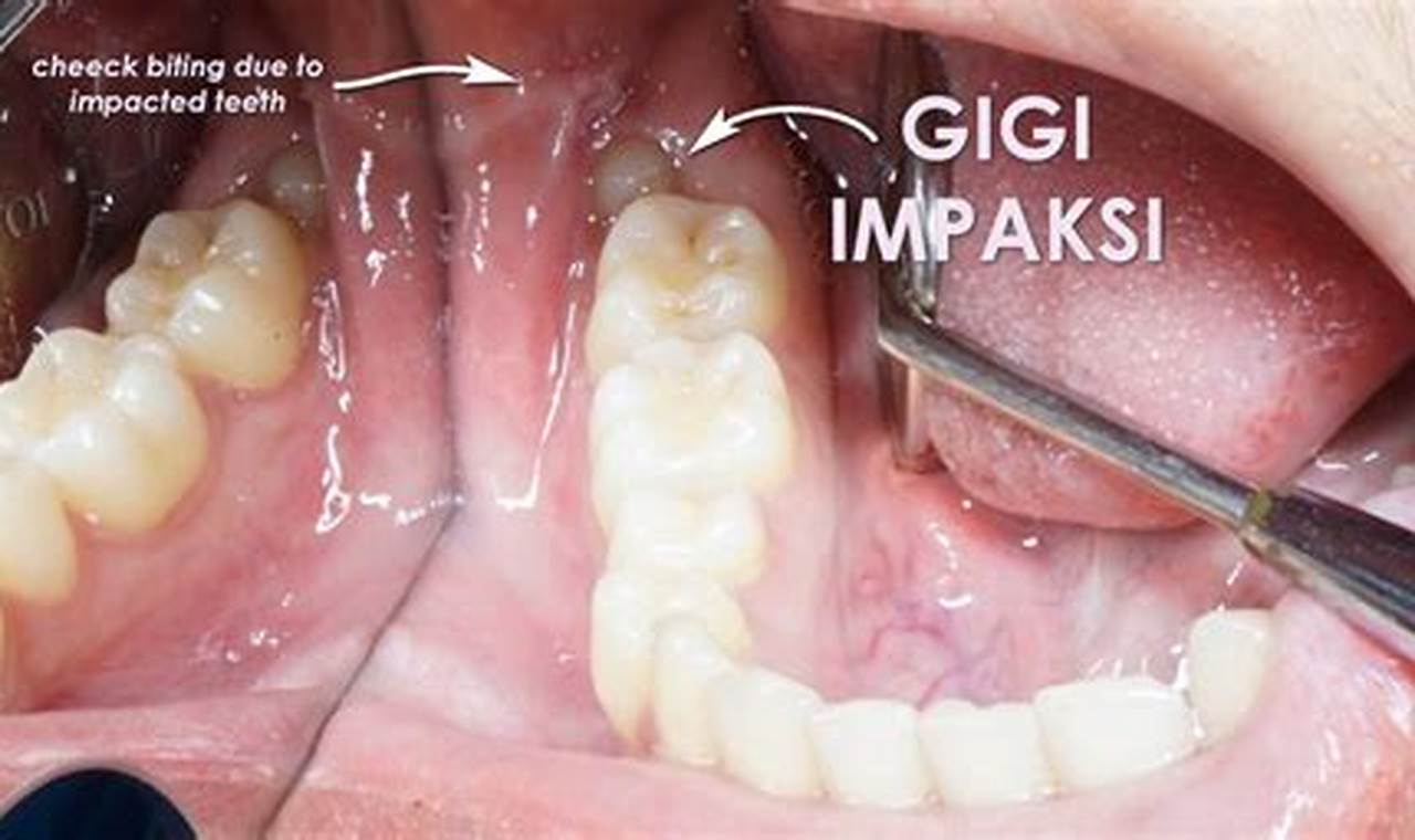 cara atasi gusi bengkak